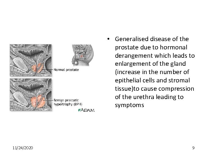  • Generalised disease of the prostate due to hormonal derangement which leads to