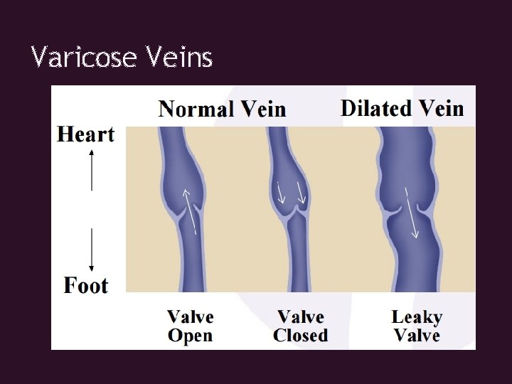 Varicose Veins 