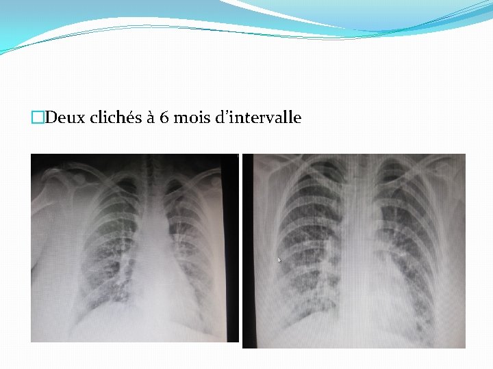�Deux clichés à 6 mois d’intervalle �Deux clichés à 6 mois d’intervalle