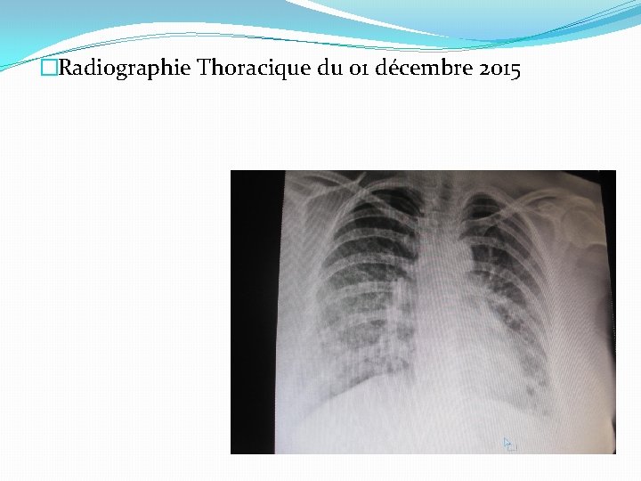 �Radiographie Thoracique du 01 décembre 2015 