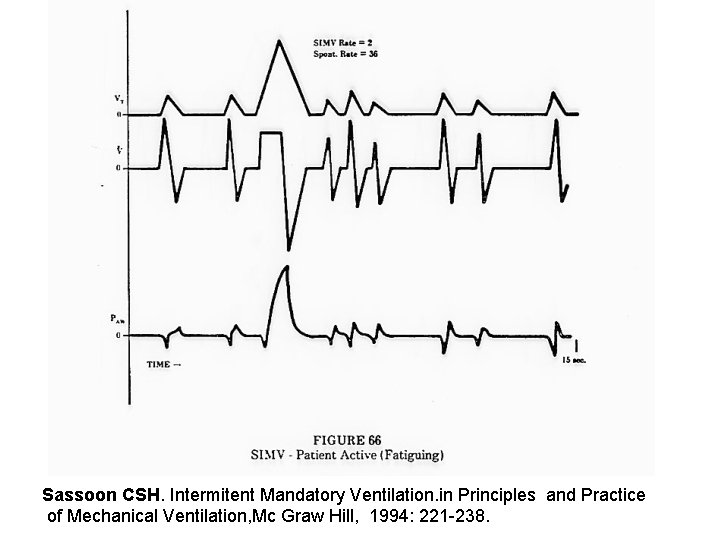 Sassoon CSH. Intermitent Mandatory Ventilation. in Principles and Practice of Mechanical Ventilation, Mc Graw