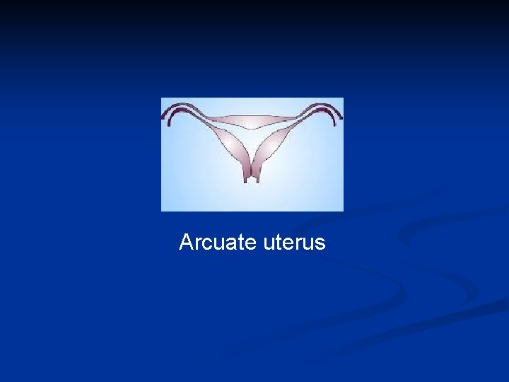 Arcuate uterus 