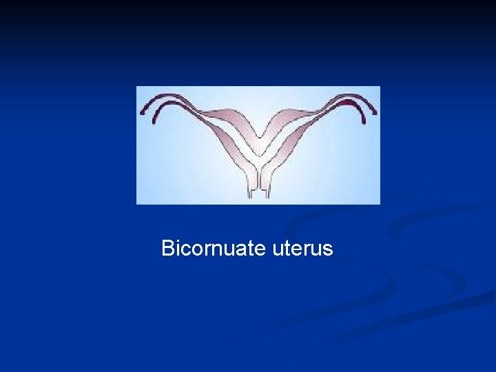 Bicornuate uterus 