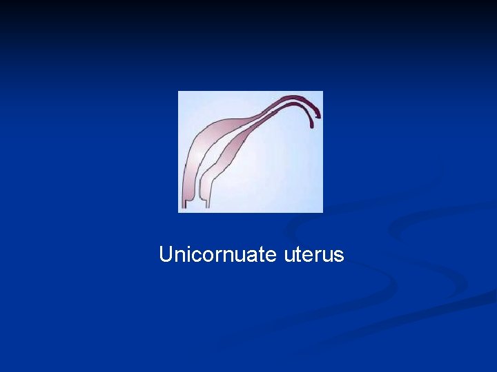 Unicornuate uterus 