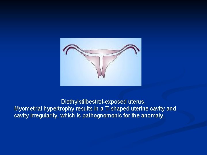 Diethylstilbestrol-exposed uterus. Myometrial hypertrophy results in a T-shaped uterine cavity and cavity irregularity, which