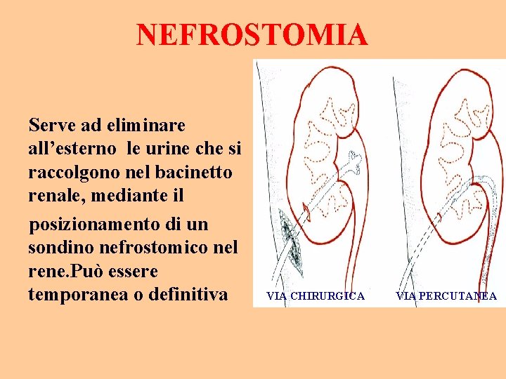 NEFROSTOMIA Serve ad eliminare all’esterno le urine che si raccolgono nel bacinetto renale, mediante