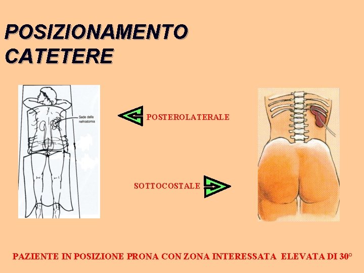 POSIZIONAMENTO CATETERE POSTEROLATERALE SOTTOCOSTALE PAZIENTE IN POSIZIONE PRONA CON ZONA INTERESSATA ELEVATA DI 30°