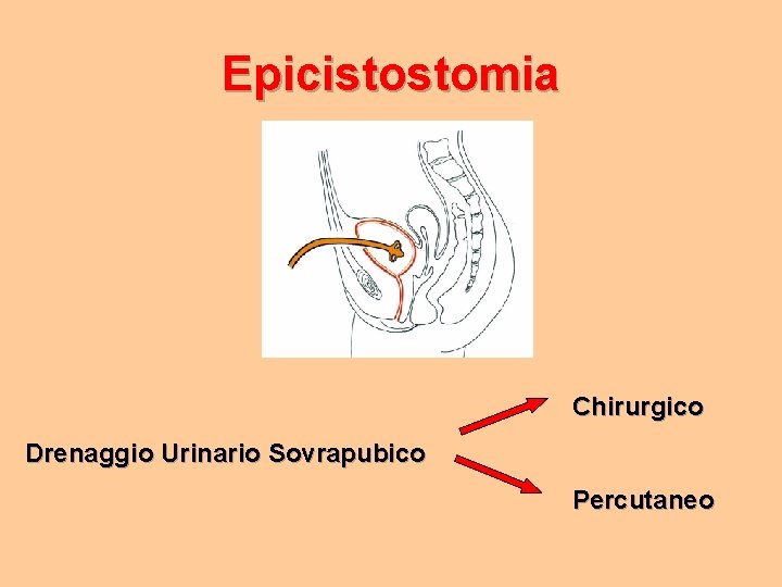 Epicistostomia Chirurgico Drenaggio Urinario Sovrapubico Percutaneo 