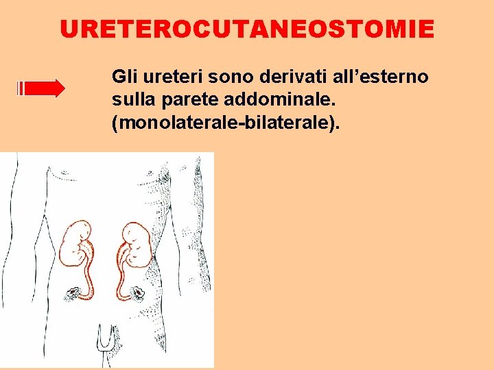 URETEROCUTANEOSTOMIE Gli ureteri sono derivati all’esterno sulla parete addominale. (monolaterale-bilaterale). 