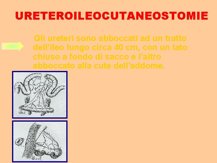 URETEROILEOCUTANEOSTOMIE Gli ureteri sono abboccati ad un tratto dell’ileo lungo circa 40 cm, con