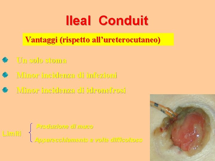 Ileal Conduit Vantaggi (rispetto all’ureterocutaneo) Un solo stoma Minor incidenza di infezioni Minor incidenza