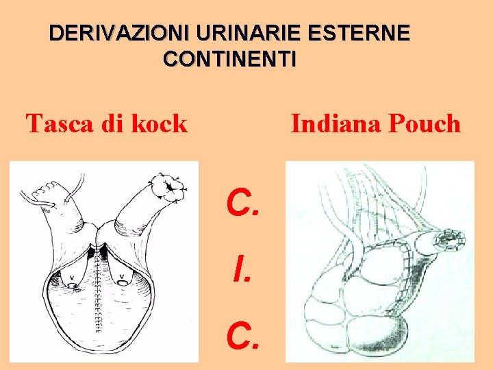 DERIVAZIONI URINARIE ESTERNE CONTINENTI Tasca di kock Indiana Pouch C. I. C. 