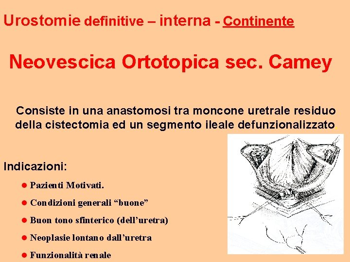Urostomie definitive – interna - Continente Neovescica Ortotopica sec. Camey Consiste in una anastomosi