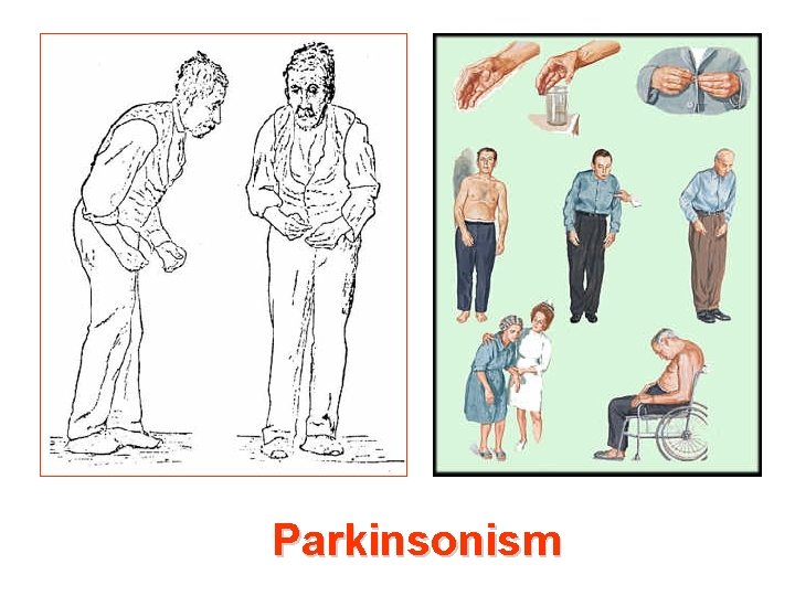 Parkinsonism 