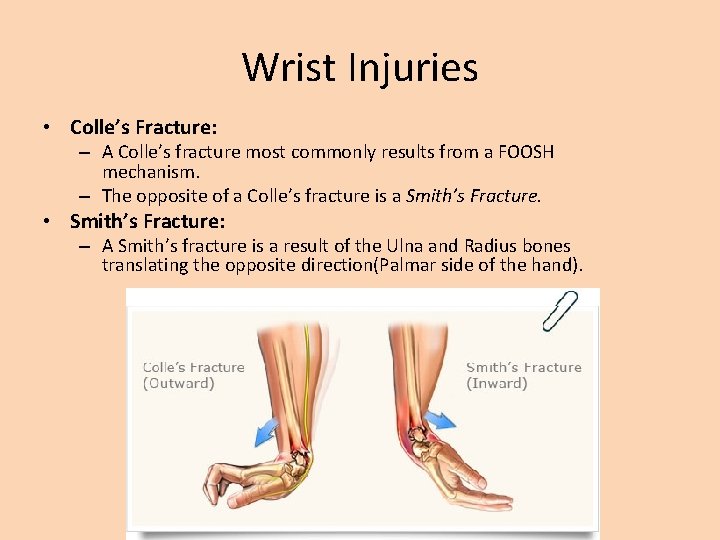 Wrist Injuries • Colle’s Fracture: – A Colle’s fracture most commonly results from a