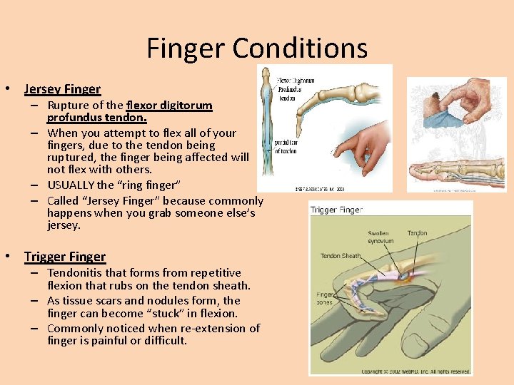 Finger Conditions • Jersey Finger – Rupture of the flexor digitorum profundus tendon. –