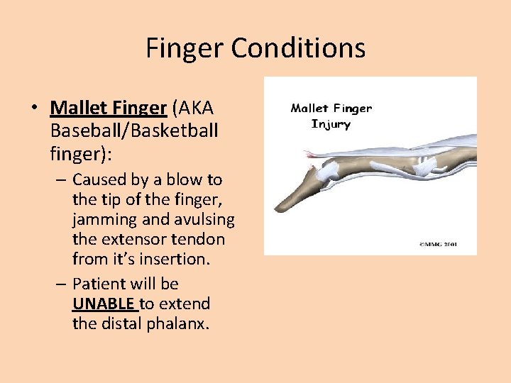 Finger Conditions • Mallet Finger (AKA Baseball/Basketball finger): – Caused by a blow to