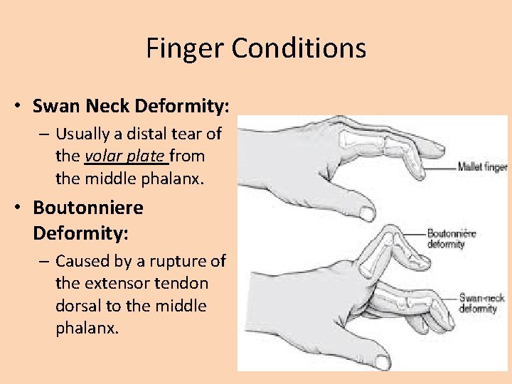 Finger Conditions • Swan Neck Deformity: – Usually a distal tear of the volar