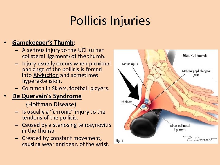 Pollicis Injuries • Gamekeeper’s Thumb: – A serious injury to the UCL (ulnar collateral