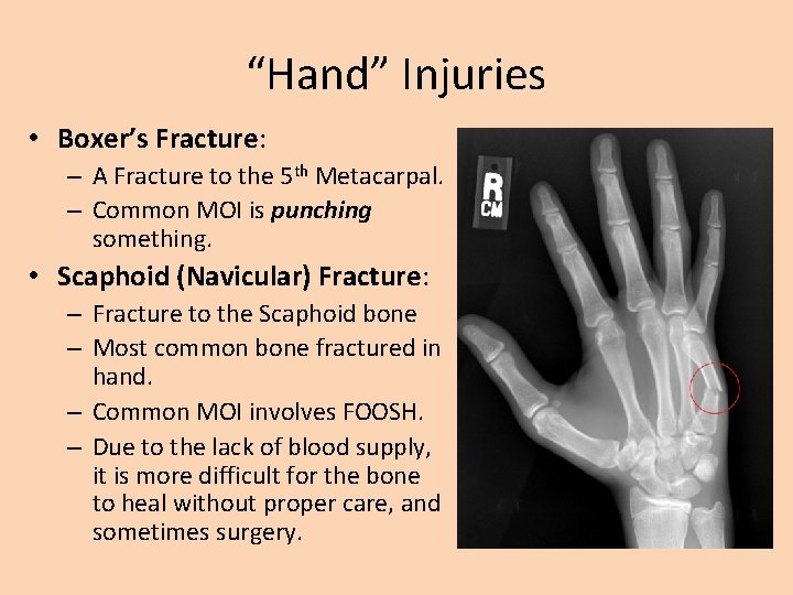 “Hand” Injuries • Boxer’s Fracture: – A Fracture to the 5 th Metacarpal. –