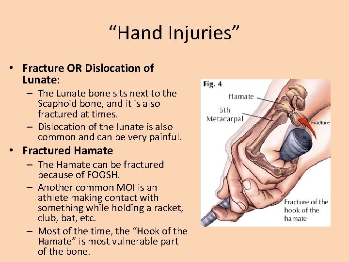 “Hand Injuries” • Fracture OR Dislocation of Lunate: – The Lunate bone sits next