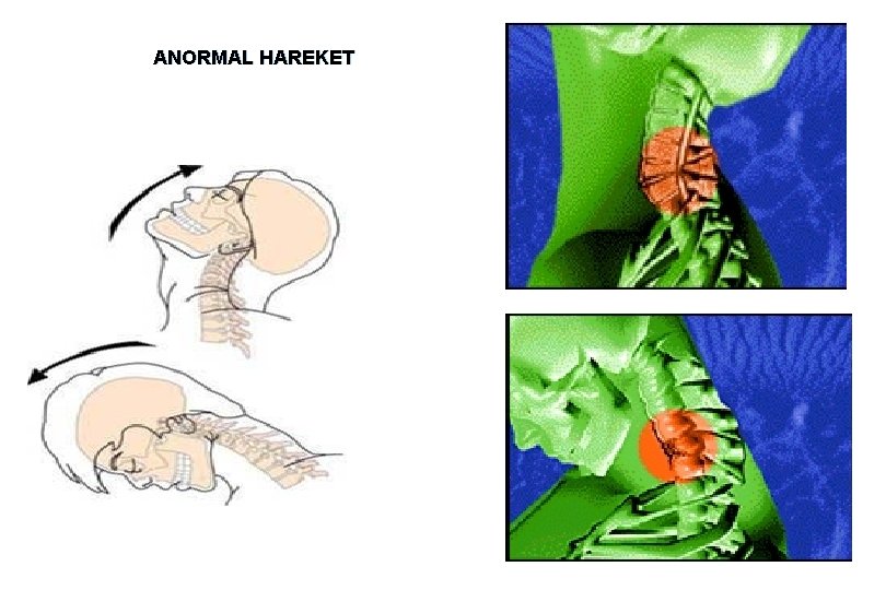 ANORMAL HAREKET 