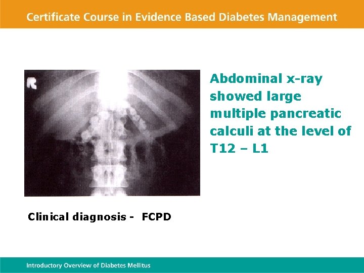 Abdominal x-ray showed large multiple pancreatic calculi at the level of T 12 –