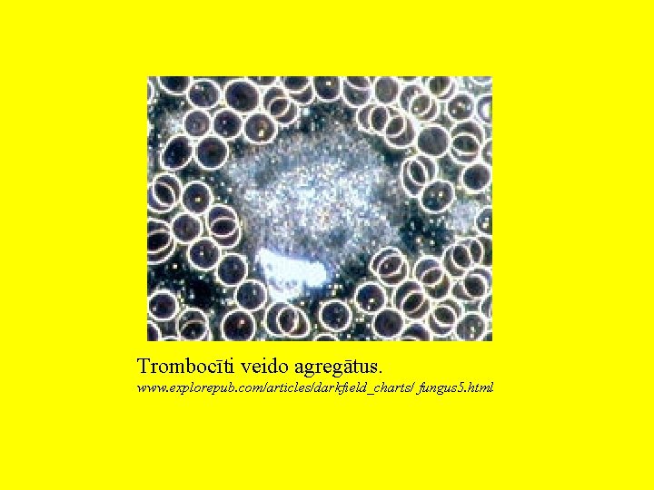 Trombocīti veido agregātus. www. explorepub. com/articles/darkfield_charts/ fungus 5. html Trombocīti veido agregātus. www. explorepub. com/articles/darkfield_charts/ fungus 5. html