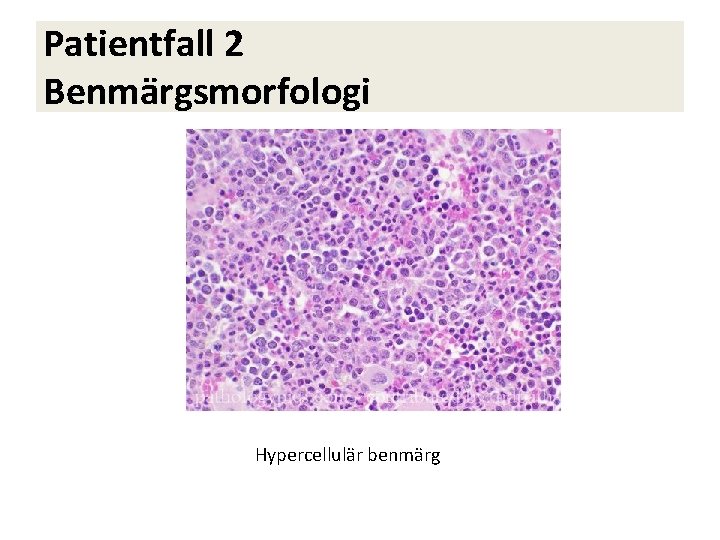 Patientfall 2 Benmärgsmorfologi Hypercellulär benmärg 