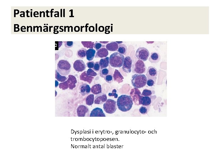 Patientfall 1 Benmärgsmorfologi Dysplasi i erytro-, granulocyto- och trombocytopoesen. Normalt antal blaster 
