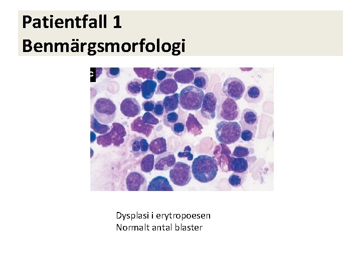 Patientfall 1 Benmärgsmorfologi Dysplasi i erytropoesen Normalt antal blaster 