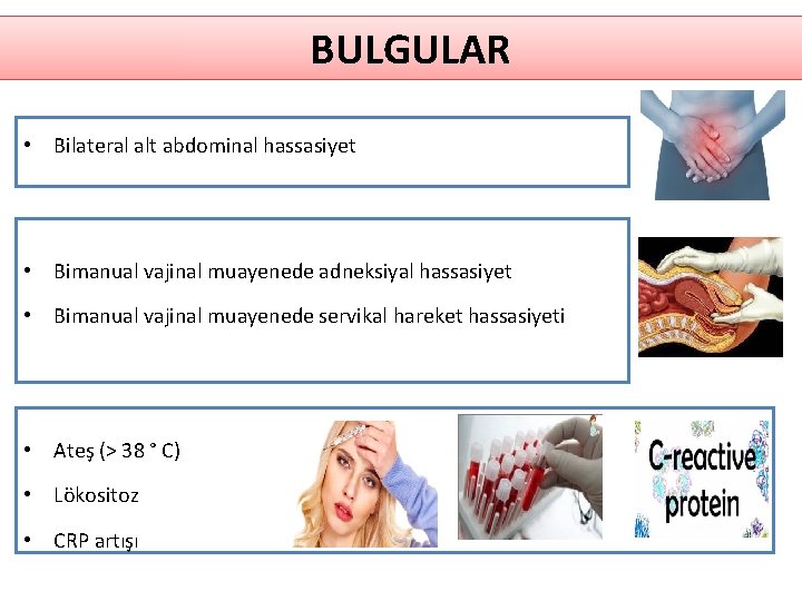 BULGULAR • Bilateral alt abdominal hassasiyet • Bimanual vajinal muayenede adneksiyal hassasiyet • Bimanual BULGULAR • Bilateral alt abdominal hassasiyet • Bimanual vajinal muayenede adneksiyal hassasiyet • Bimanual