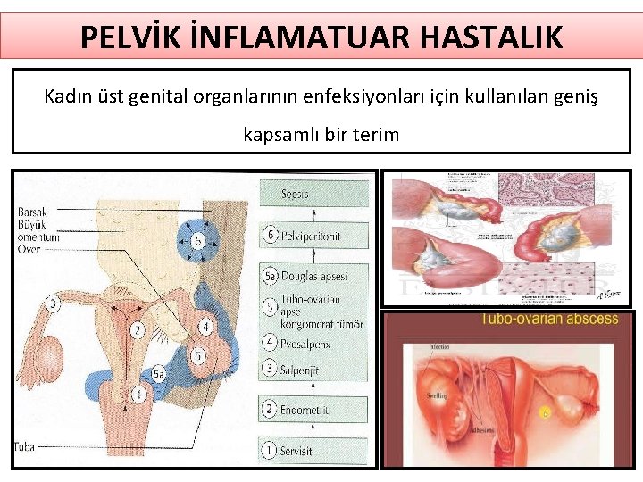 PELVİK İNFLAMATUAR HASTALIK Kadın üst genital organlarının enfeksiyonları için kullanılan geniş kapsamlı bir terim