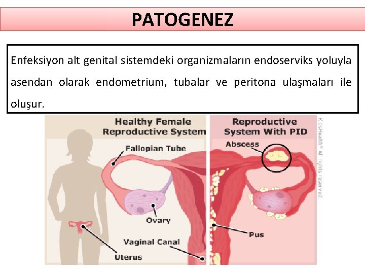PATOGENEZ Enfeksiyon alt genital sistemdeki organizmaların endoserviks yoluyla asendan olarak endometrium, tubalar ve peritona