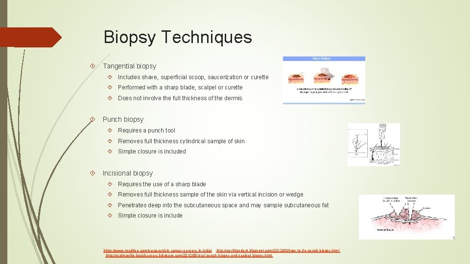 Biopsy Techniques Tangential biopsy Includes shave, superficial scoop, saucerization or curette Performed with a