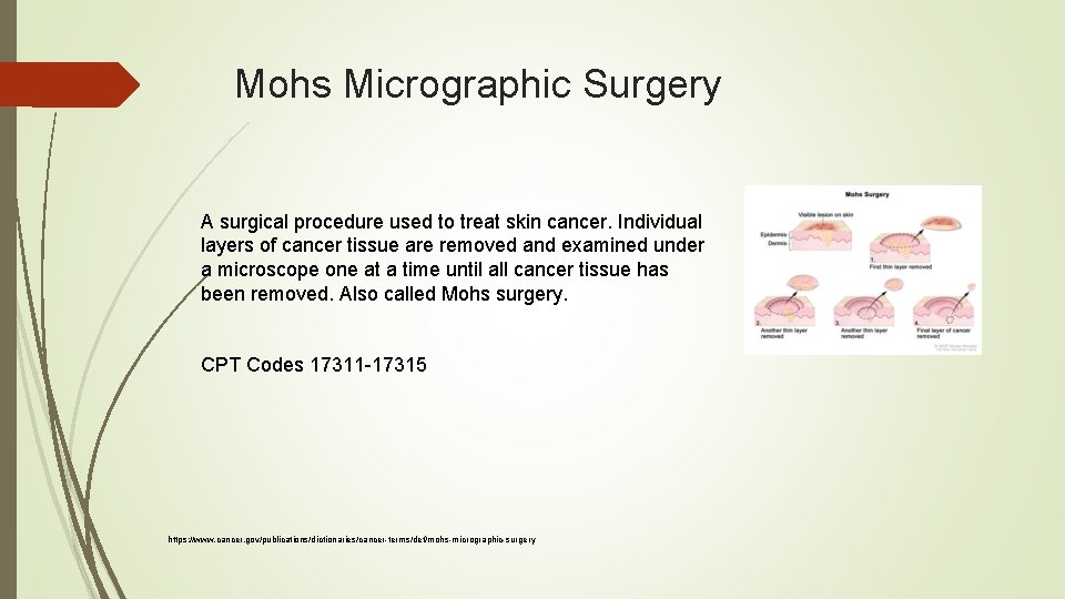 Mohs Micrographic Surgery A surgical procedure used to treat skin cancer. Individual layers of