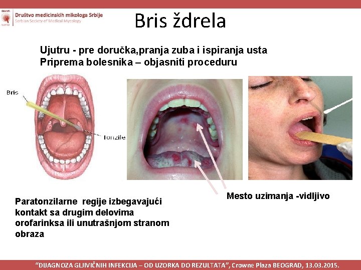 Bris ždrela Ujutru - pre doručka, pranja zuba i ispiranja usta Priprema bolesnika –