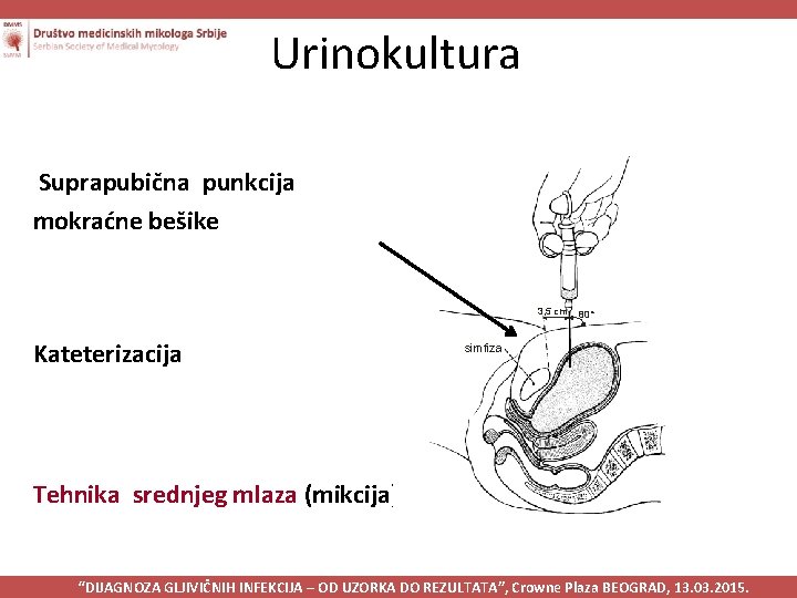 Urinokultura Suprapubična punkcija mokraćne bešike 3, 5 cm Kateterizacija 80° simfiza Tehnika srednjeg mlaza