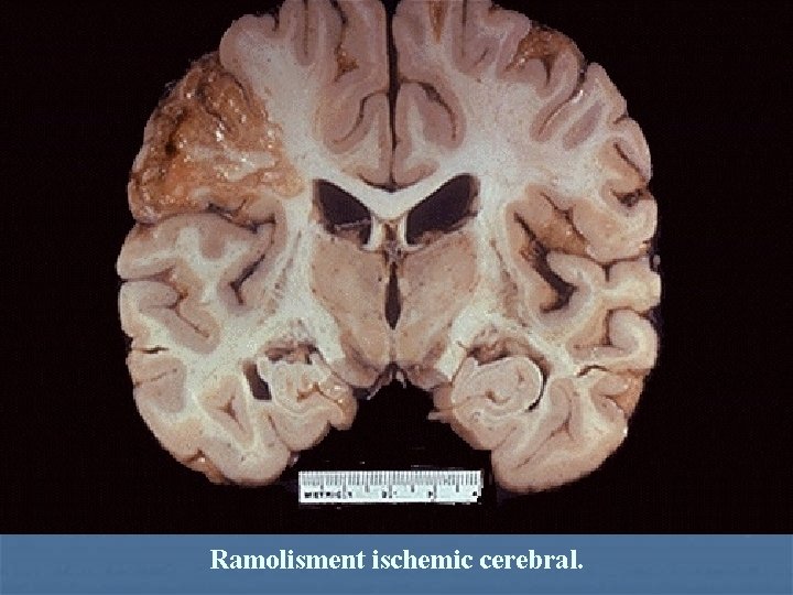 Ramolisment ischemic cerebral. 