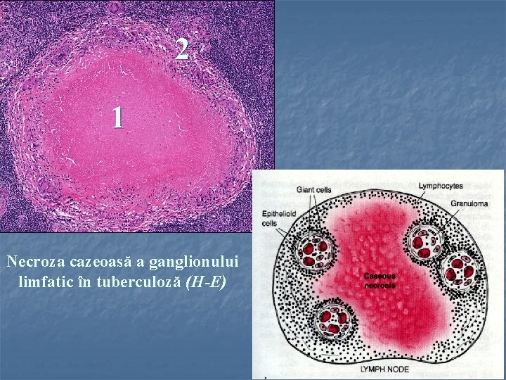 2 1 Necroza cazeoasă a ganglionului limfatic în tuberculoză (H-E) 