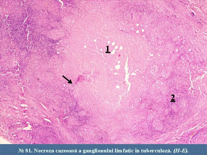 1 2 № 81. Necroza cazeoasă a ganglionului limfatic în tuberculoză. (H-E). 