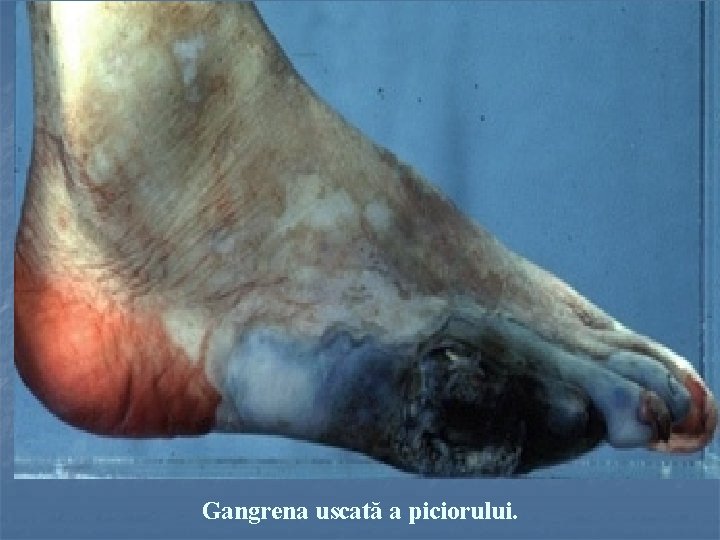Gangrena uscată a piciorului. 