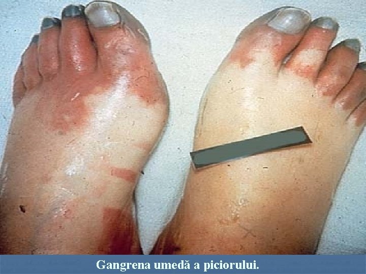  Gangrena umedă a piciorului. 