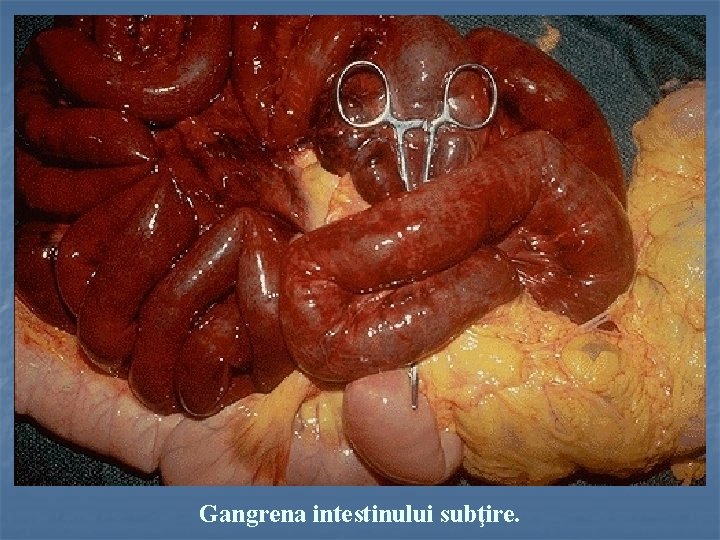 Gangrena intestinului subţire. 