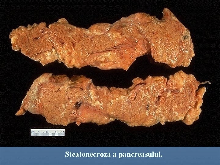 Steatonecroza a pancreasului. 