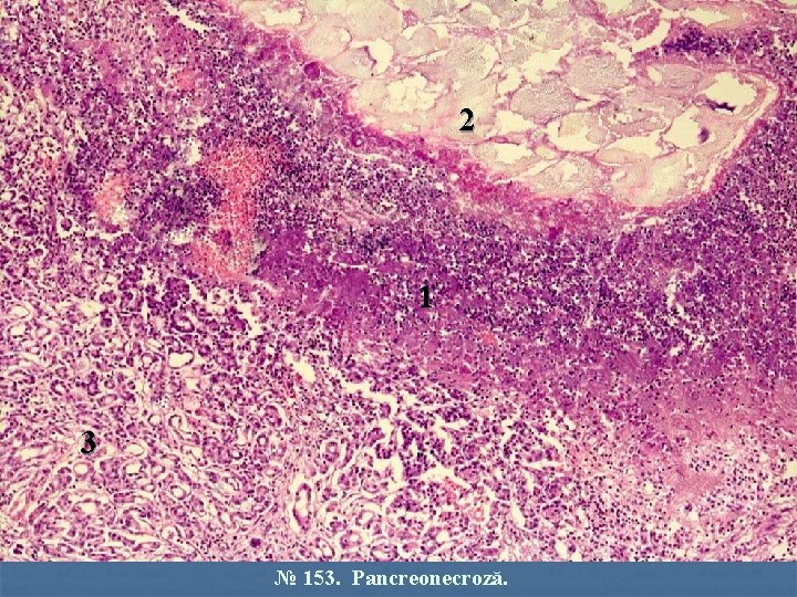 2 1 3 № 153. Pancreonecroză. 