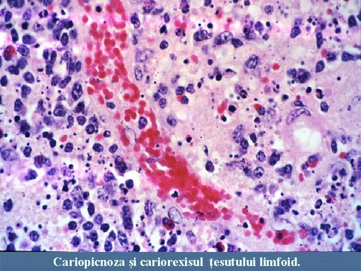 Cariopicnoza și cariorexisul țesutului limfoid. 
