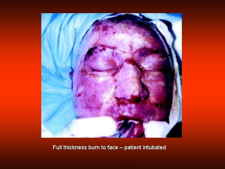 Full thickness burn to face – patient intubated 