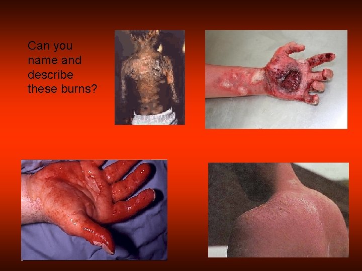 Can you name and describe these burns? 