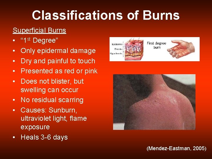 Classifications of Burns Superficial Burns • “ 1 st Degree” • Only epidermal damage